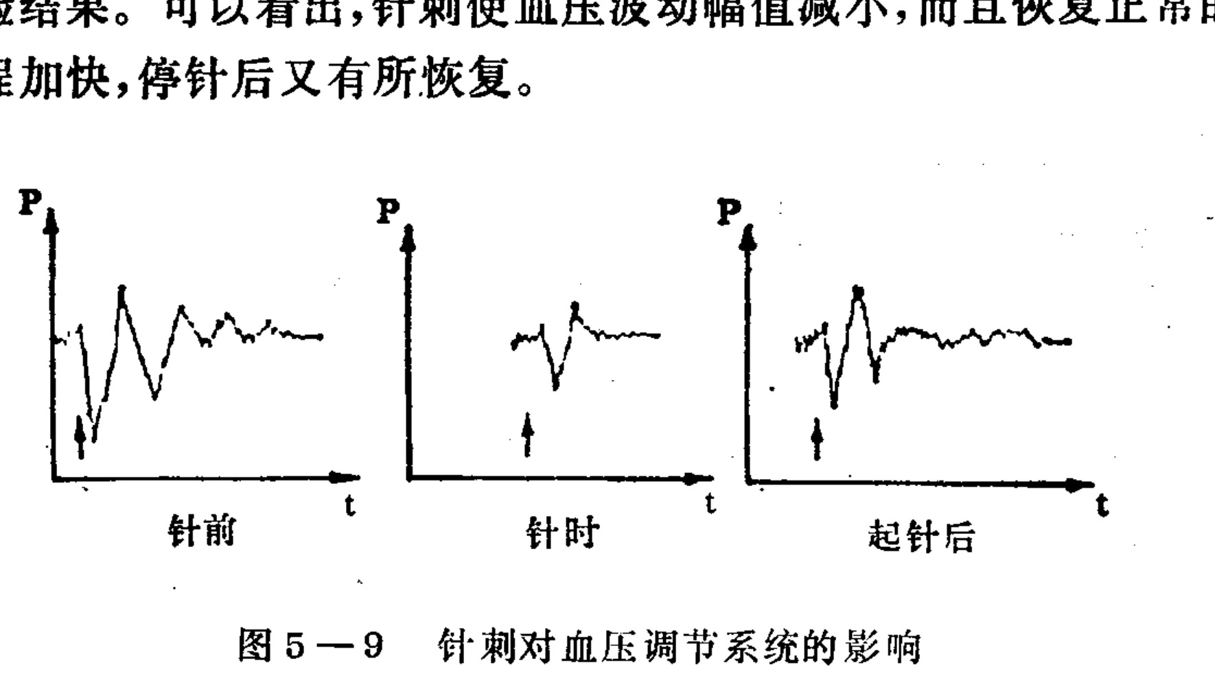 A scientific illustration containing three line graphs arranged horizontally, labeled 'Before needle', 'During needle', and 'After needle'. Each graph plots Pressure (P) on the vertical axis against time (t) on the horizontal axis. The curves show fluctuations in blood pressure with a small upward arrow pointing to the x-axis on each timeline, indicating the start of the intervention.